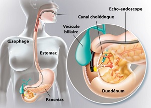 L Echo endoscopie Gastro64
