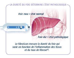 Le Fibroscan - Gastro64